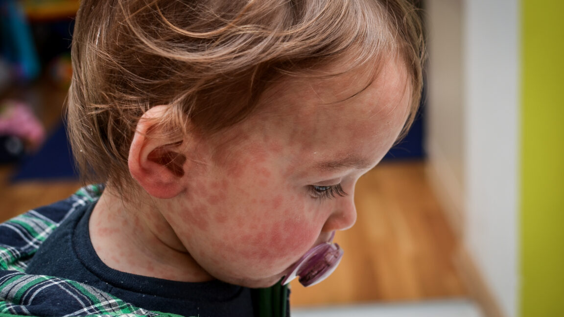 nine-unvaccinated-people-hospitalized-as-texas-measles-outbreak-doubles
