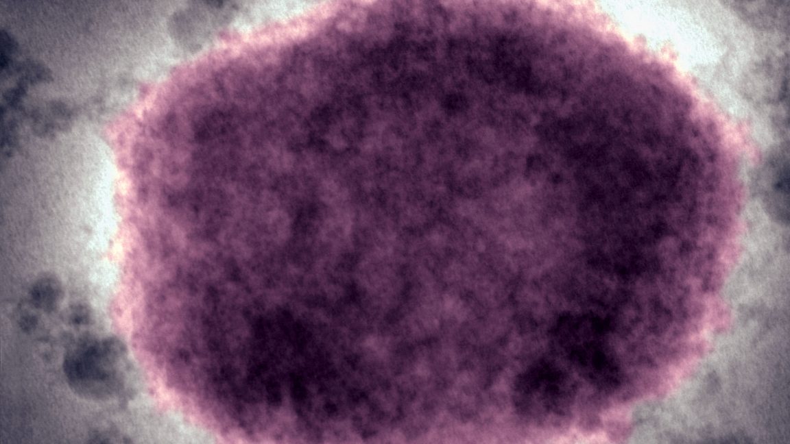 in-2022,-the-world-axed-a-disease-name-seen-as-racist-us-just-switched-back.