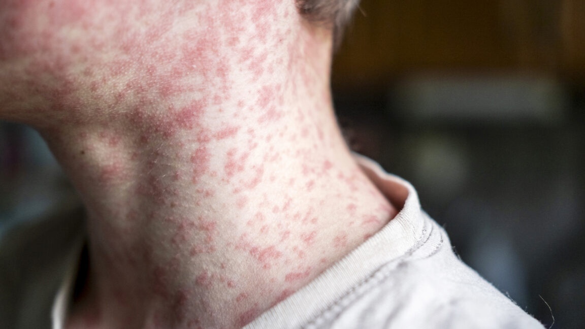 measles-outbreak-in-sc-sends-150-unvaccinated-kids-into-21-day-quarantine