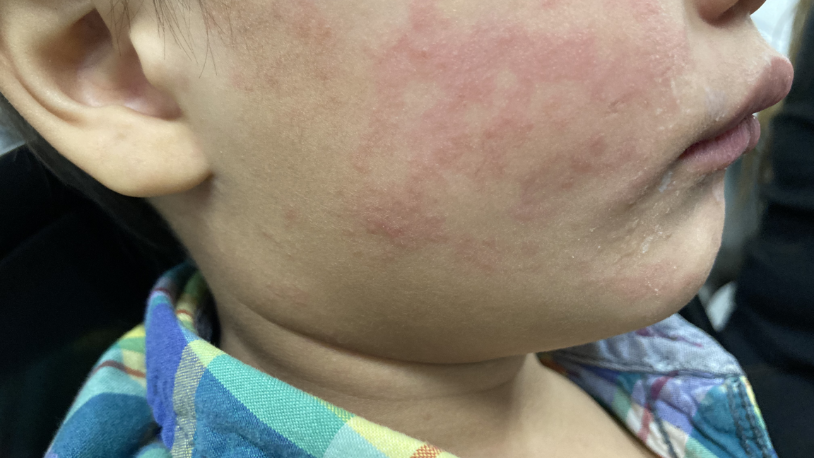 measles-continues-raging-in-south-carolina;-99-new-cases-since-tuesday